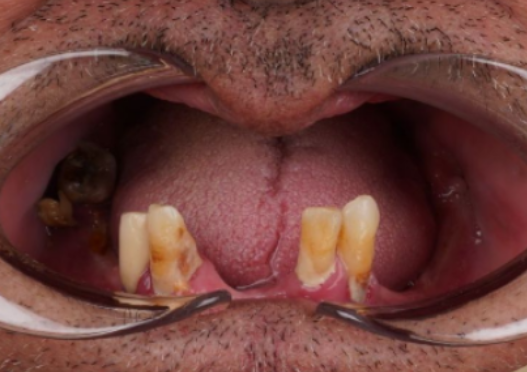 antes2 protocolos dentário dentistas moema senhor de idade