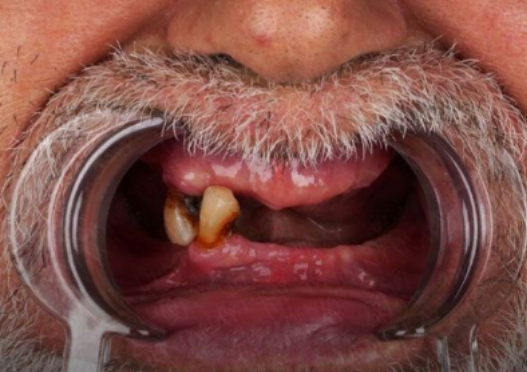 antes3 protocolos dentário dentistas moema senhor de idade